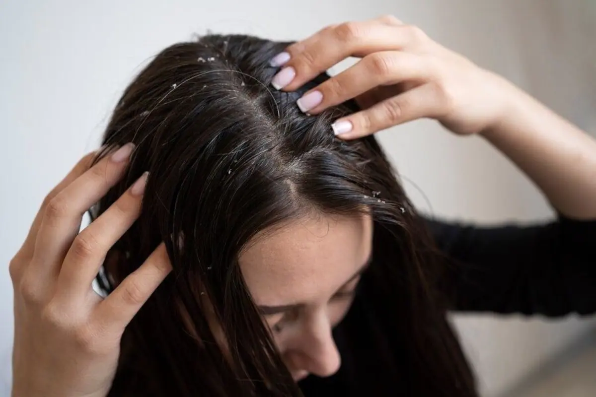 How to Get Rid of Dandruff Naturally