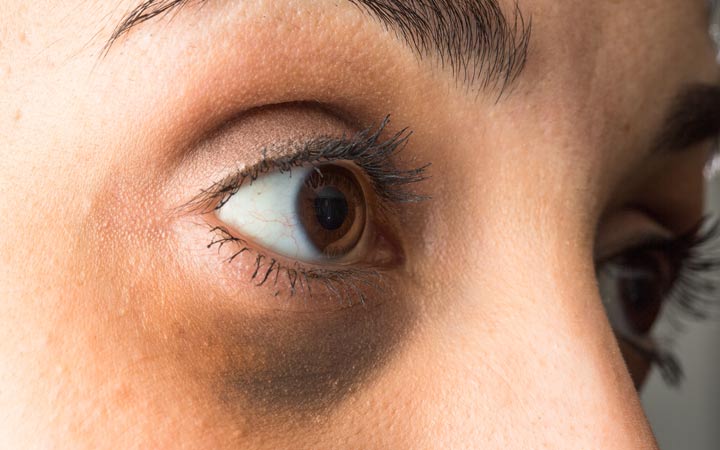 7 natural remedies to lighten dark circles under the eyes